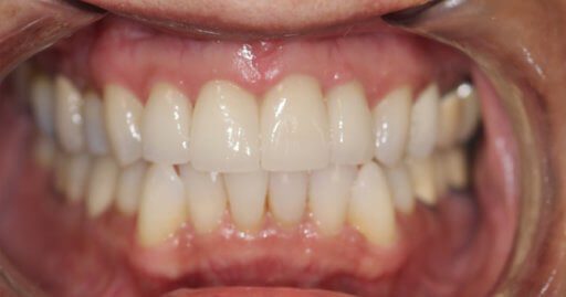 patient after photo