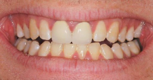 Teeth-2-Before patient before photo
