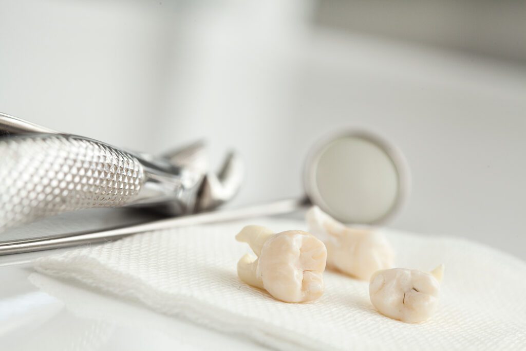 Removed wisdom tooth on white papertowel
