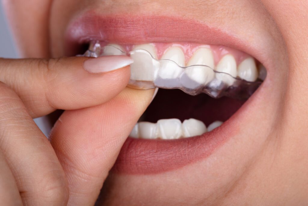 Woman Putting Transparent Aligner In Teeth