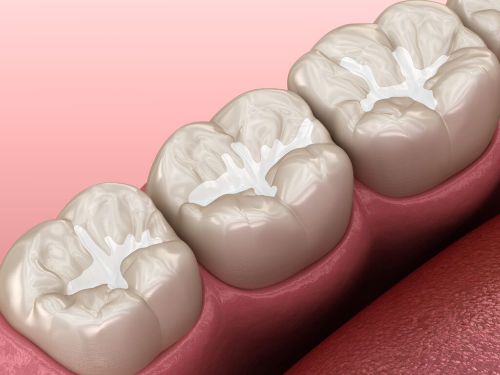 Molar Fissure dental fillings, Medically accurate 3D illustration