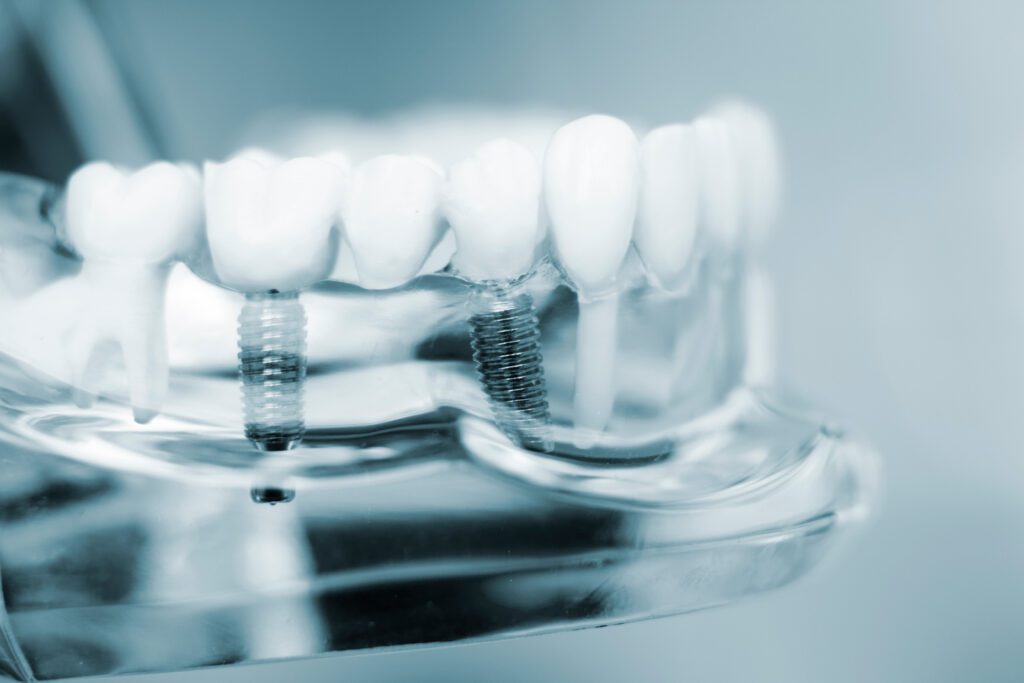 Dentists dental teeth implant