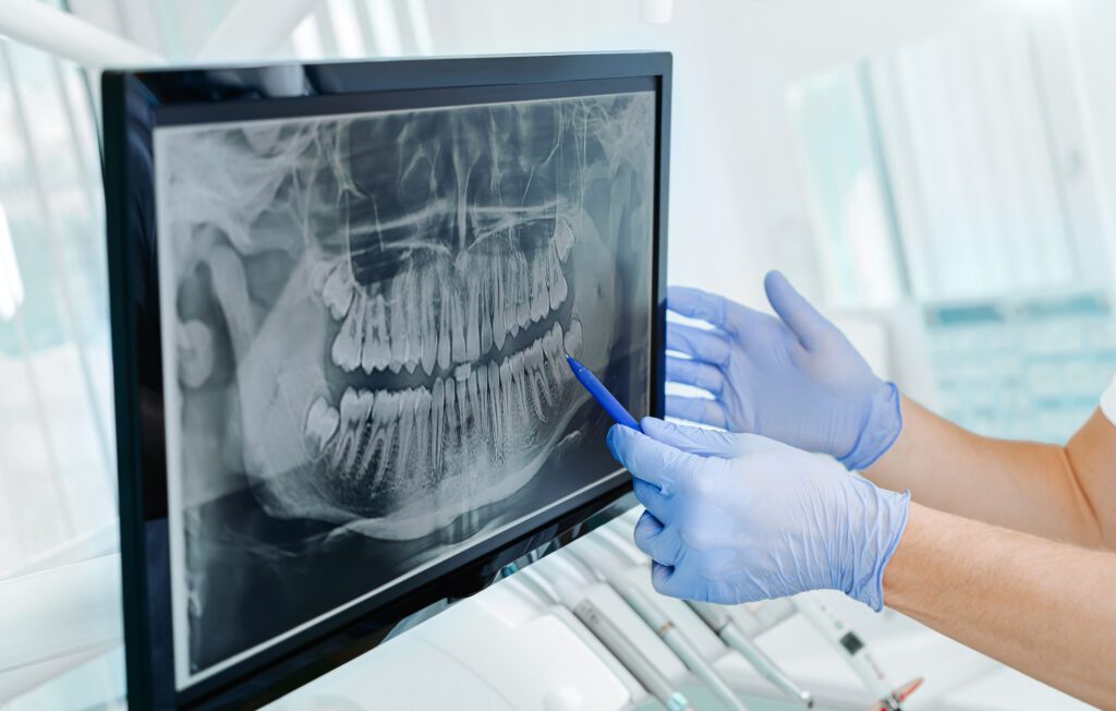 Hands doctor dentist in gloves show the teeth on x-ray on digita
