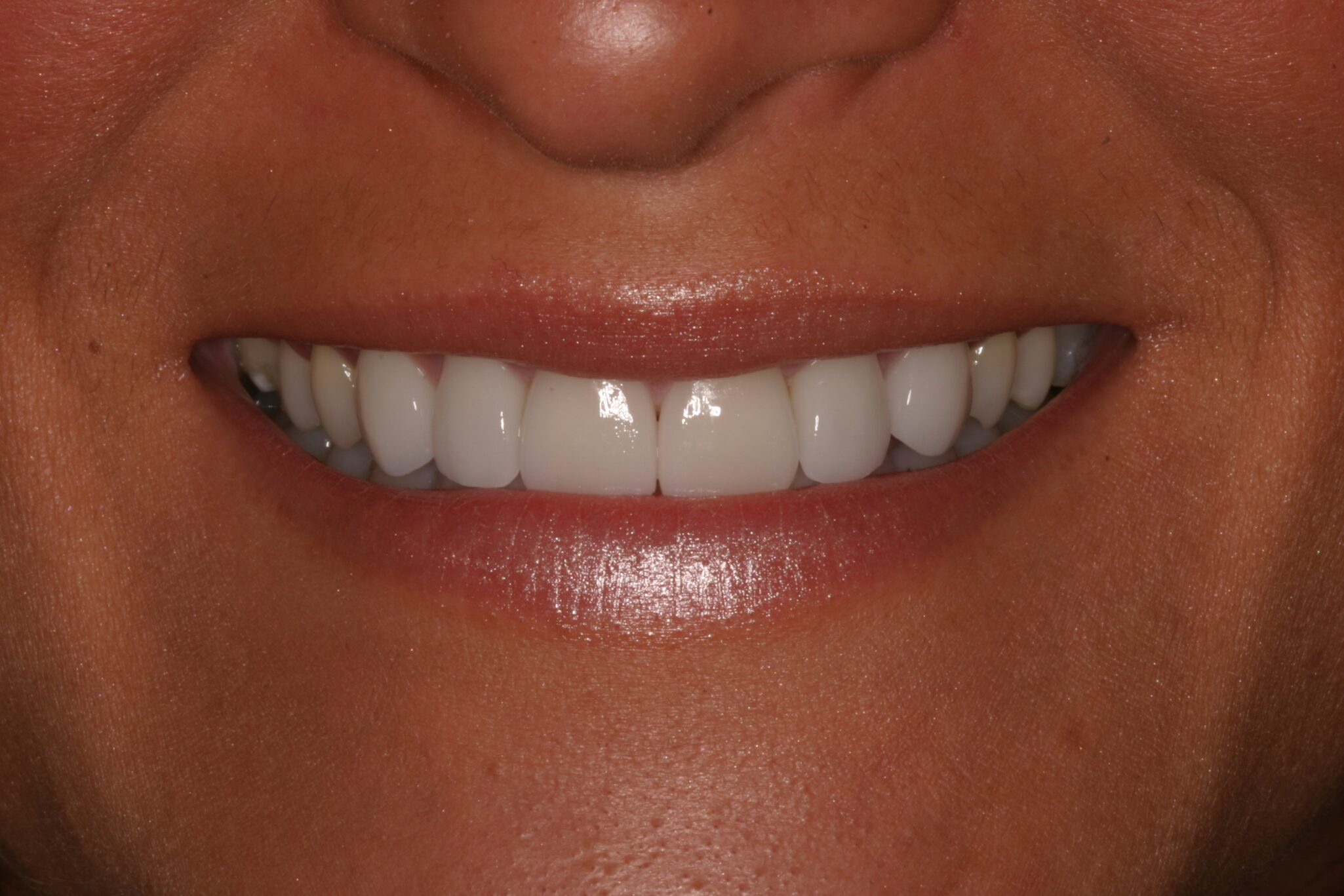 After photo of client smile