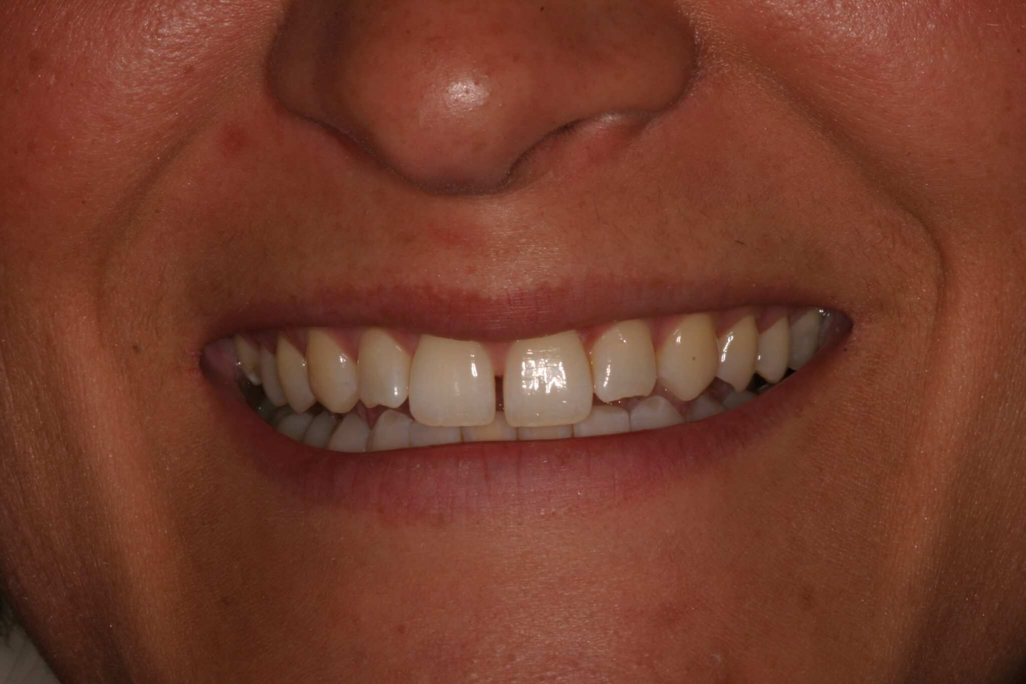CS-Smile-B4 Before photo of client's teeth