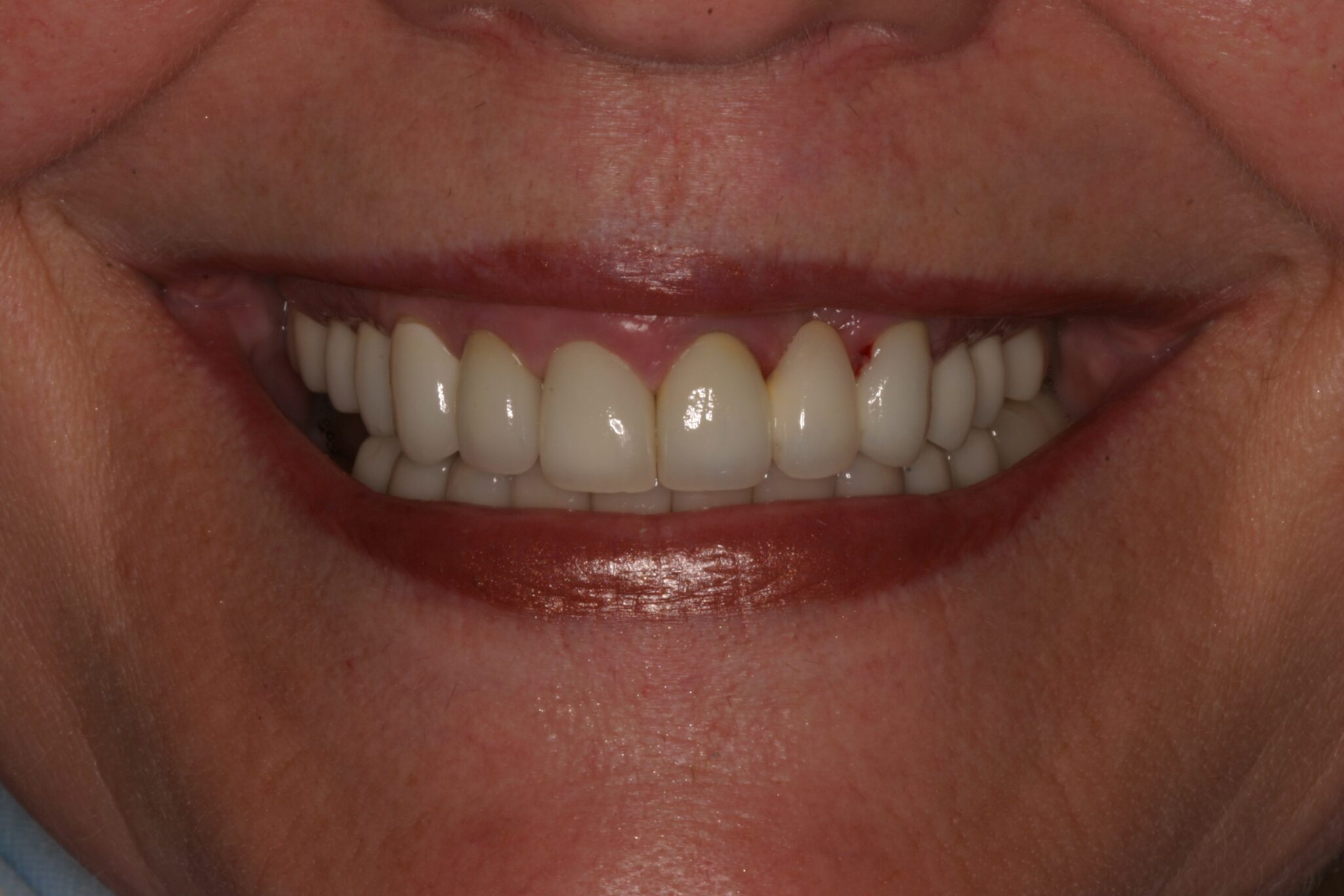 After photo of client