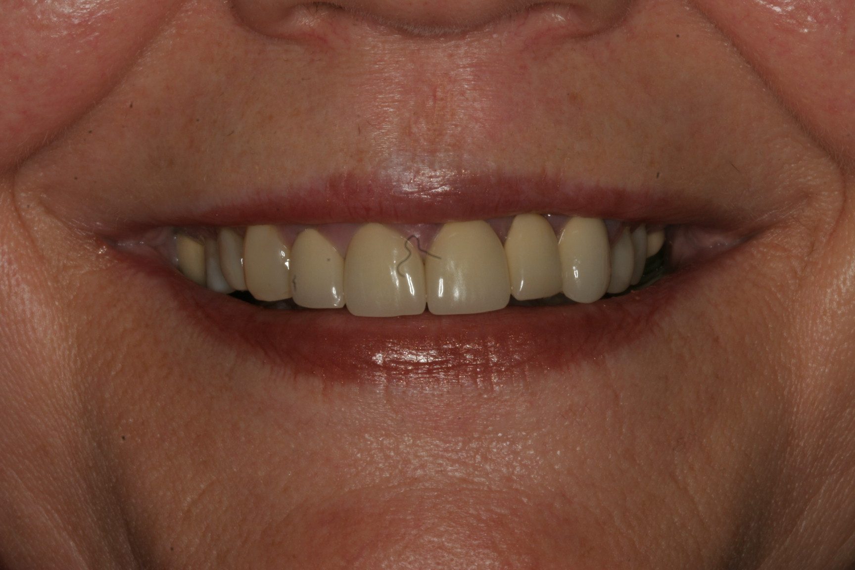 EF-Smile-B4 Before photo of client