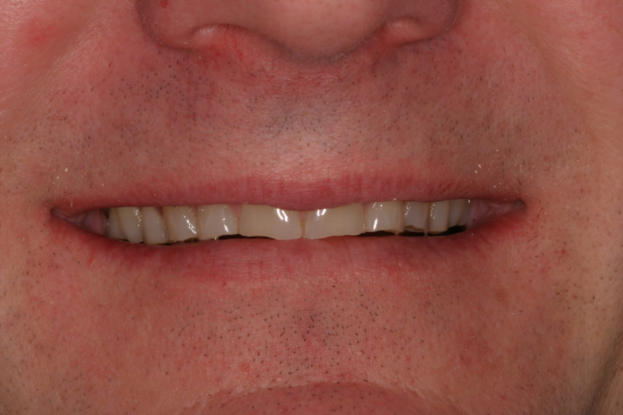 GO-Smile-B4 Before photo of male client