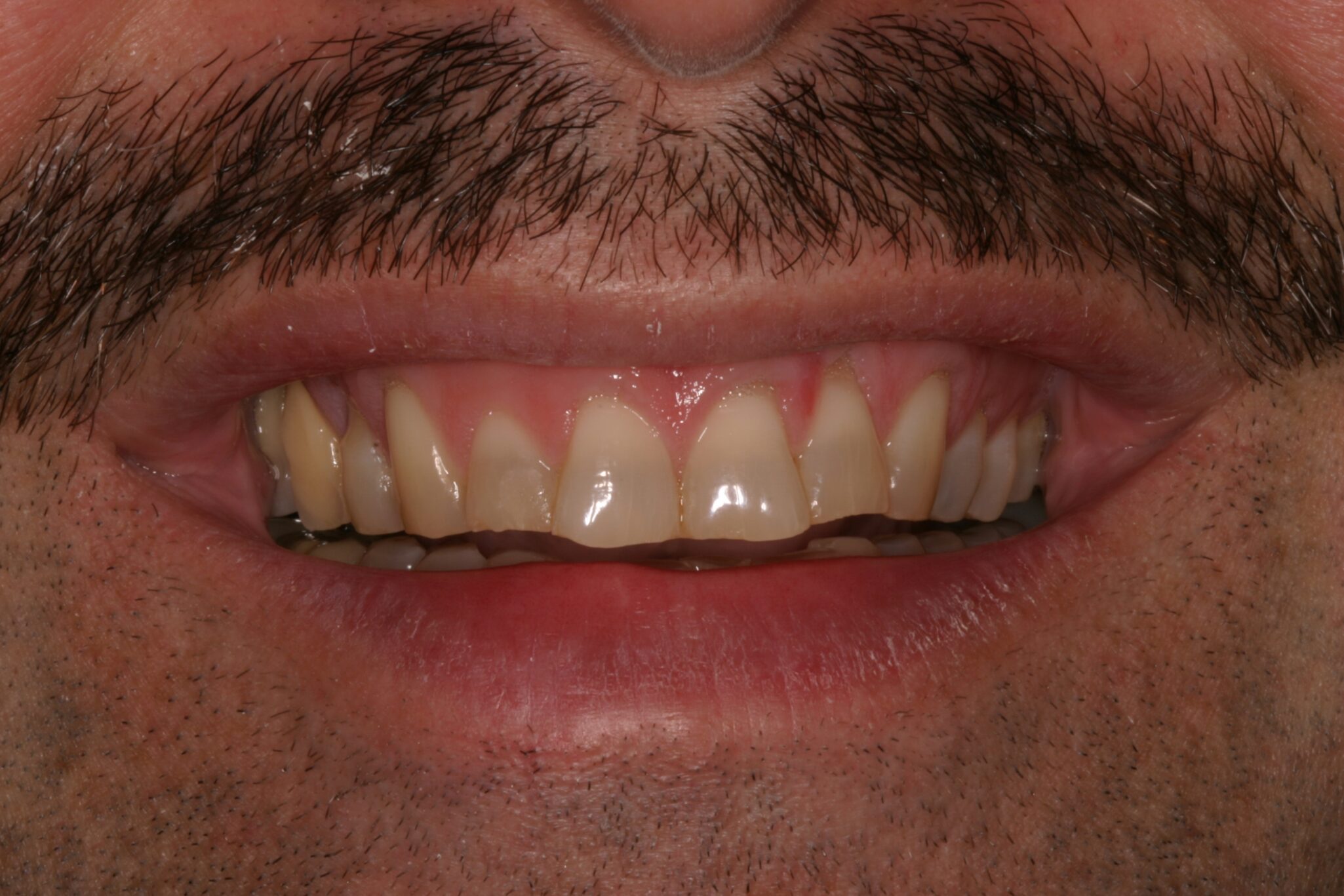 JA-Smile-B4 Client smiling before dental procedure