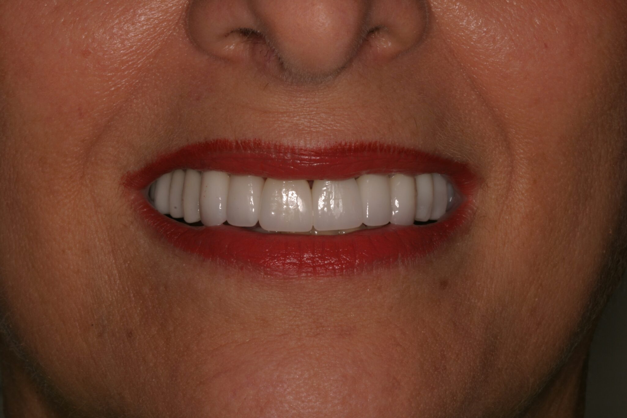 Client after teeth whitening