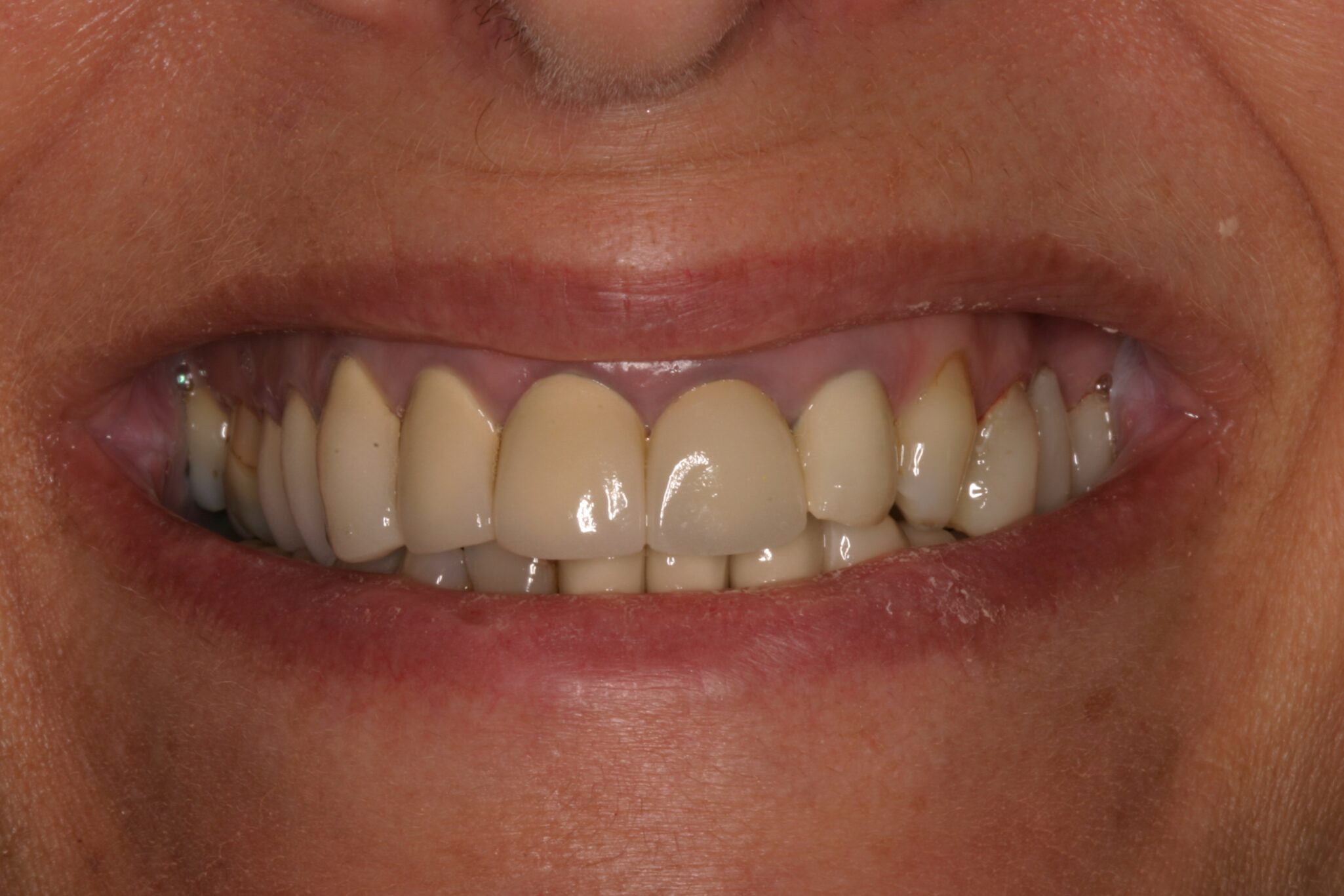 MW-Smile-B4 Client smiling before treatment