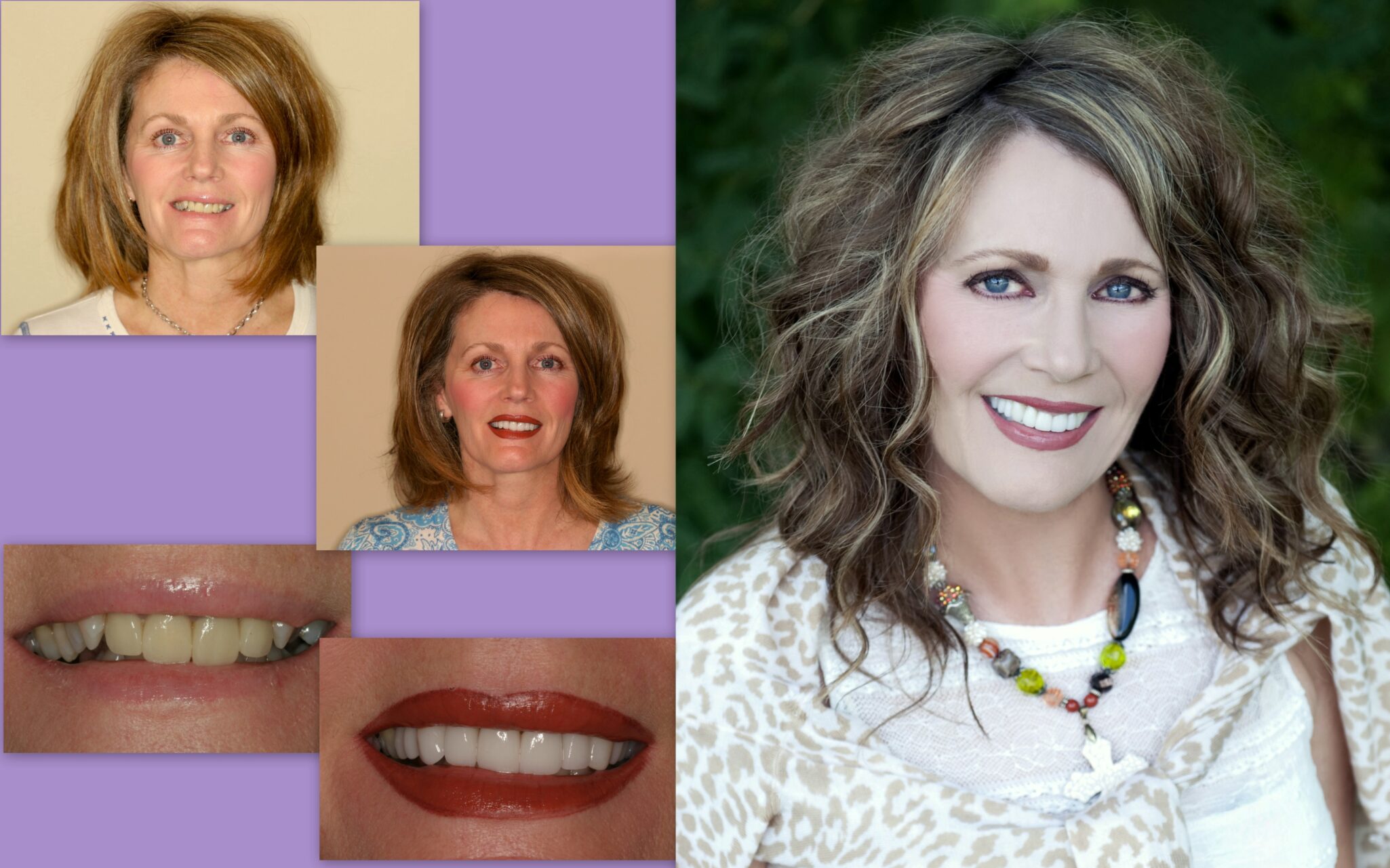 Before and after dental photos of female client