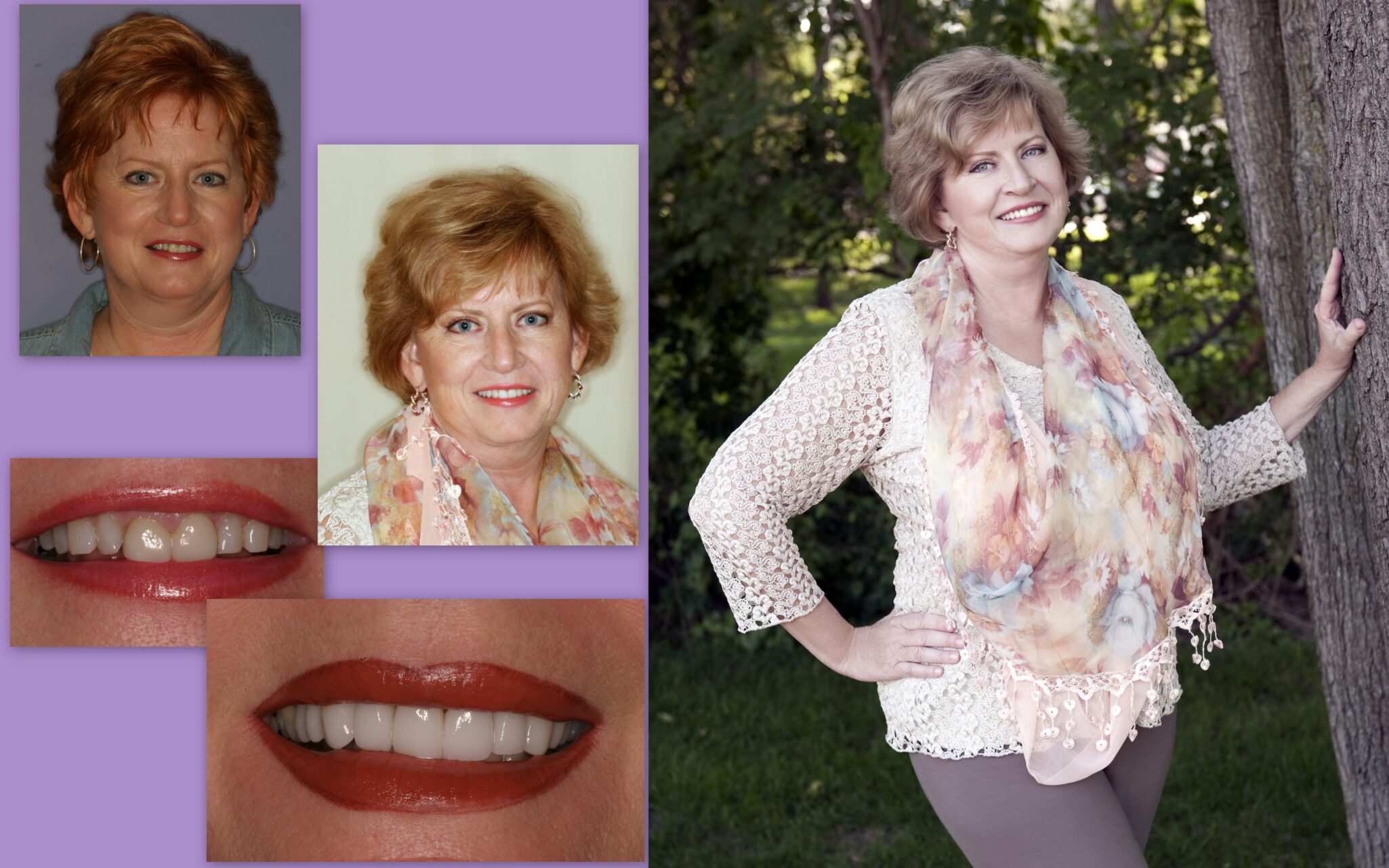 Before and after of woman's dental work