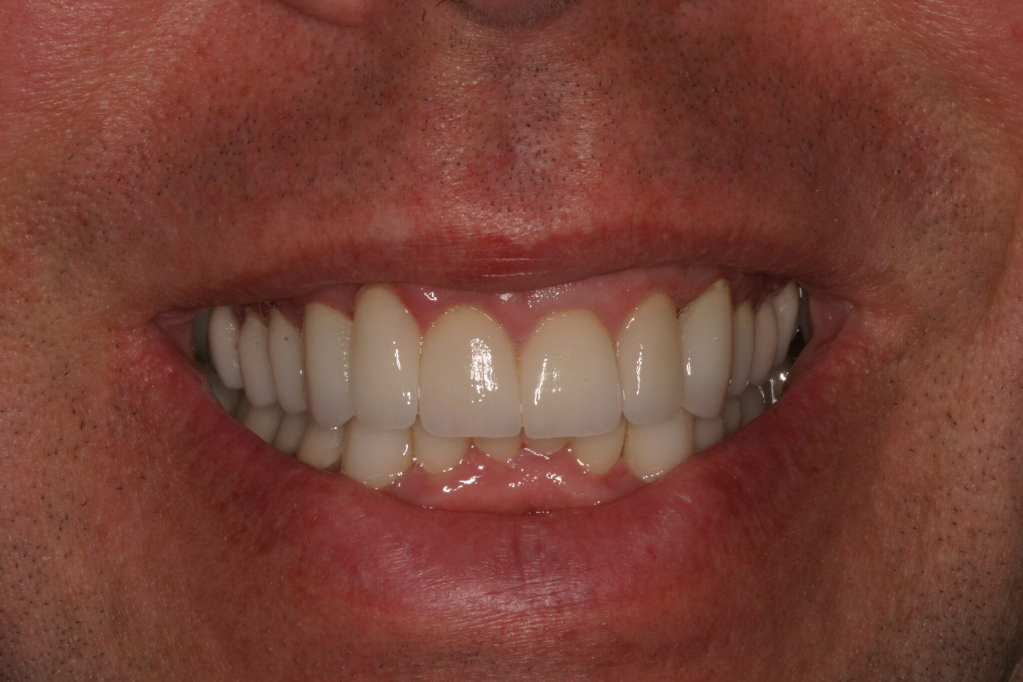 After photo showing straight teeth