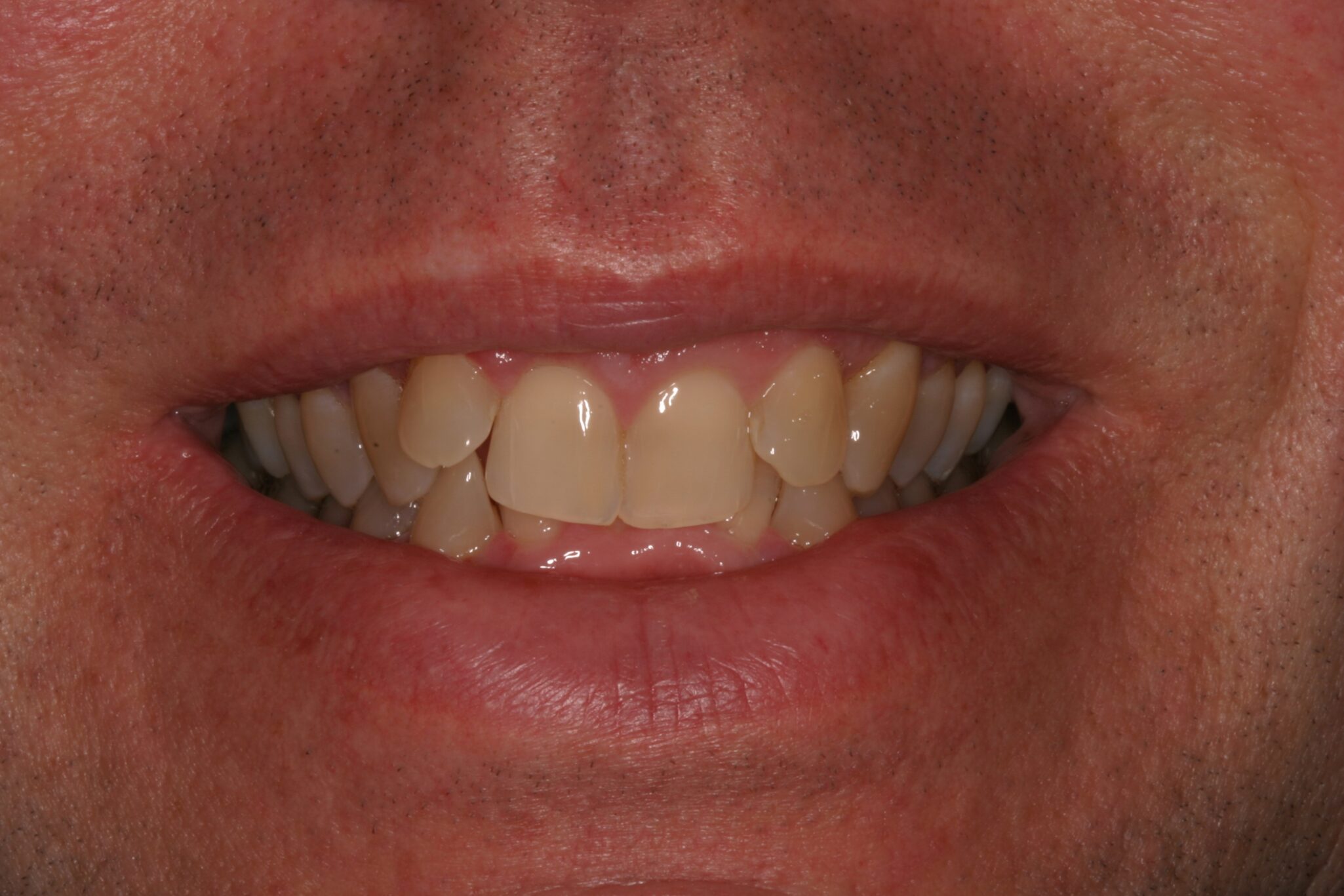 TE-Smile-B4 Uneven smile