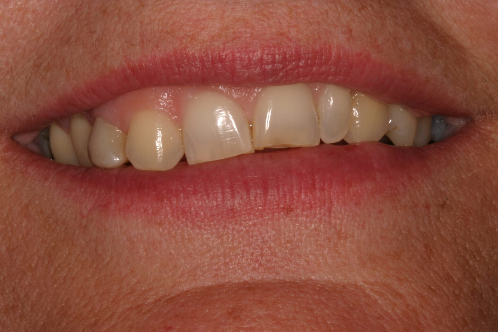 Thursday_03_29_12_945AM5 Crooked teeth