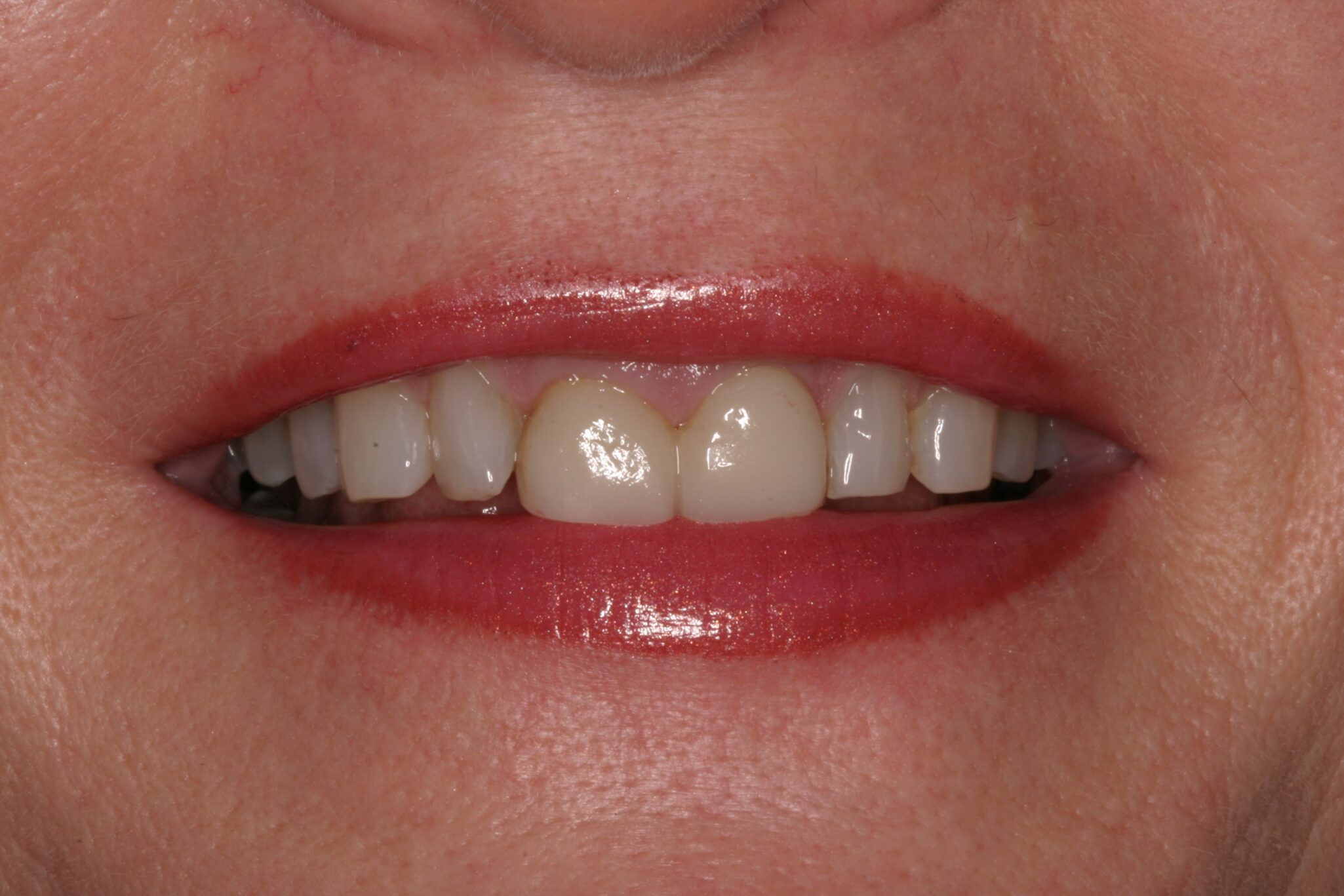 Wednesday_02_25_15_258PM2 Photo of patient's smile