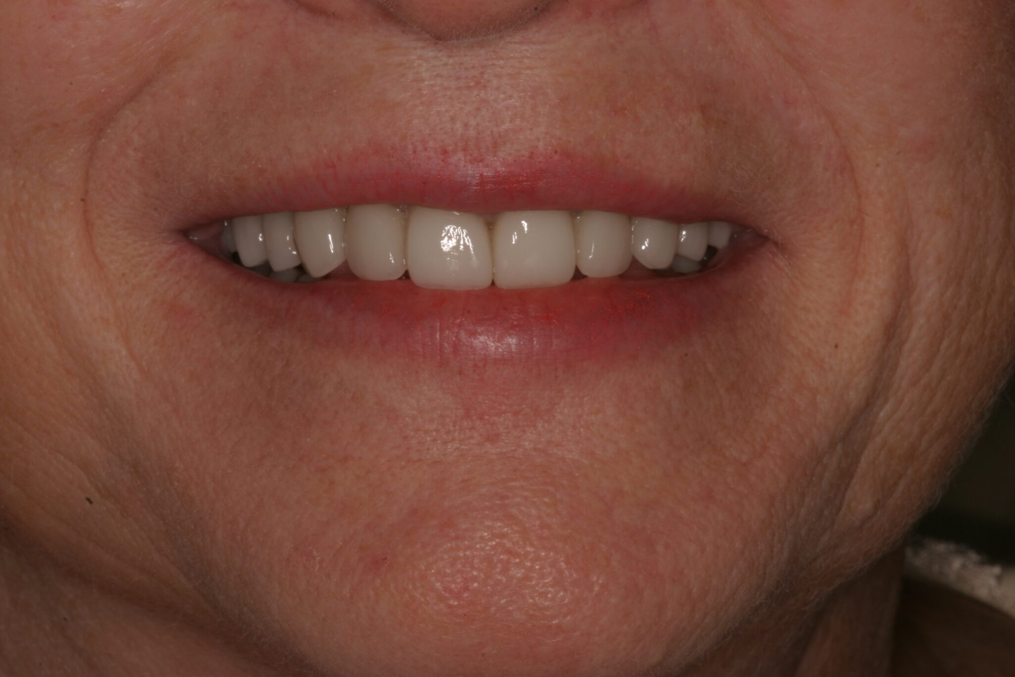 Photo of patient's smile