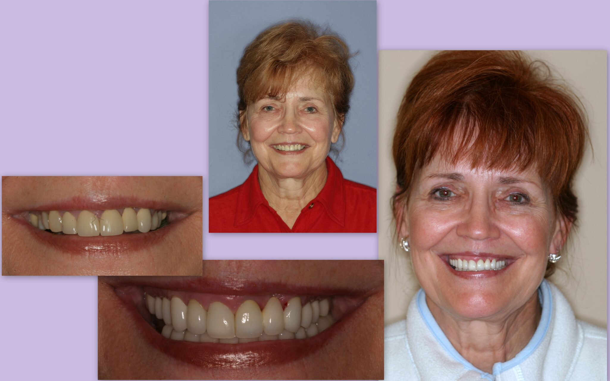 Before and after collage of mature female client