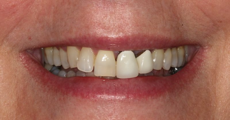Where Lasting Smiles Begin - veneers