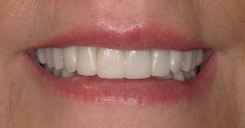 Where Lasting Smiles Begin - veneers