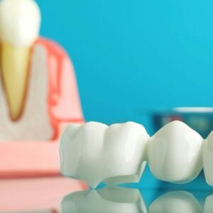 Where Lasting Smiles Begin - Snap-on Veneers